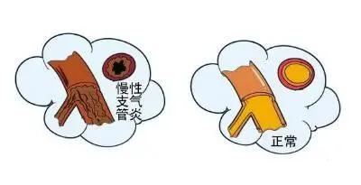 冬季咳嗽反反复复不见好？送你三味中药，化痰消食、降气平喘