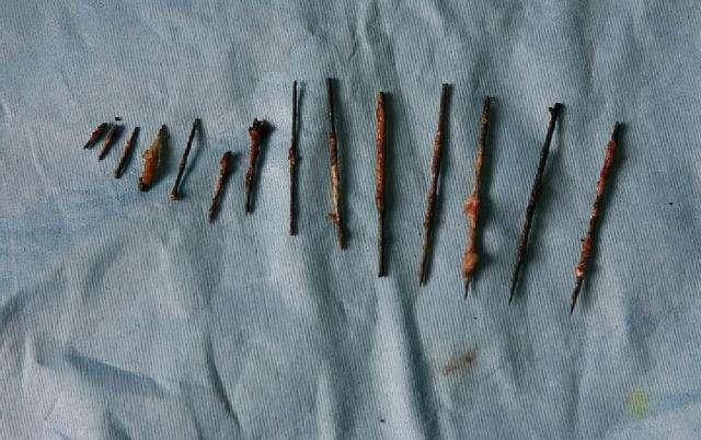 2004年，云南农妇从头到脚查出26根缝衣针，医生：1岁前扎入的