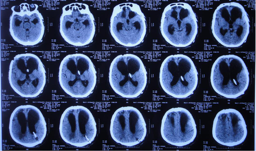 脑外伤颅骨修补术和分流术后脑积水加重致昏迷