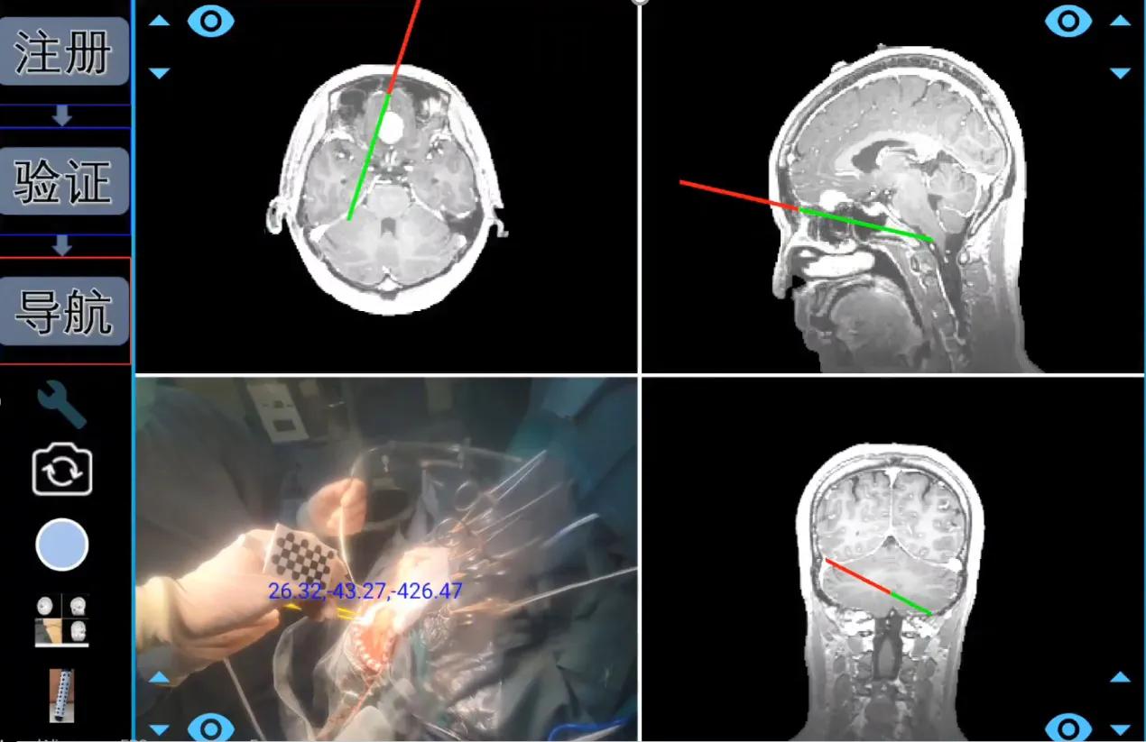 手术配上GPS 北京协和医院与腾讯联合发布国产手术导航系统