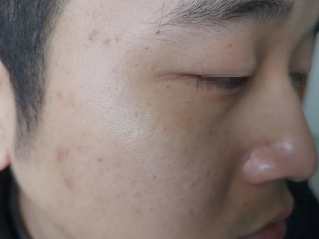一个人脸上有几种皮肤病？