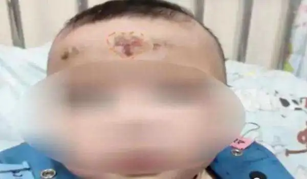 10个月女婴，被家人刮痧毁了脸