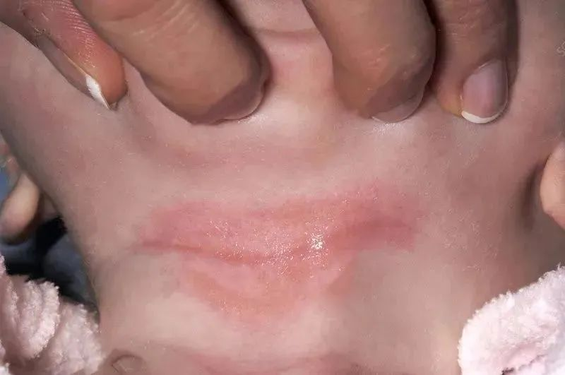 夏天孩子身上常见的几种小疙瘩,再痒也别抠,小心越来越多