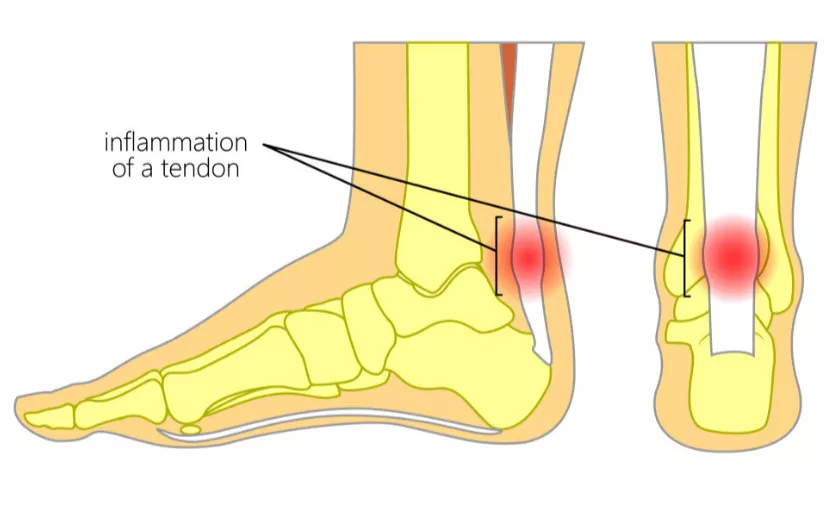 脚底疼痛部位图解(一份“双脚疼痛图解”，详解不同位置脚疼原因)