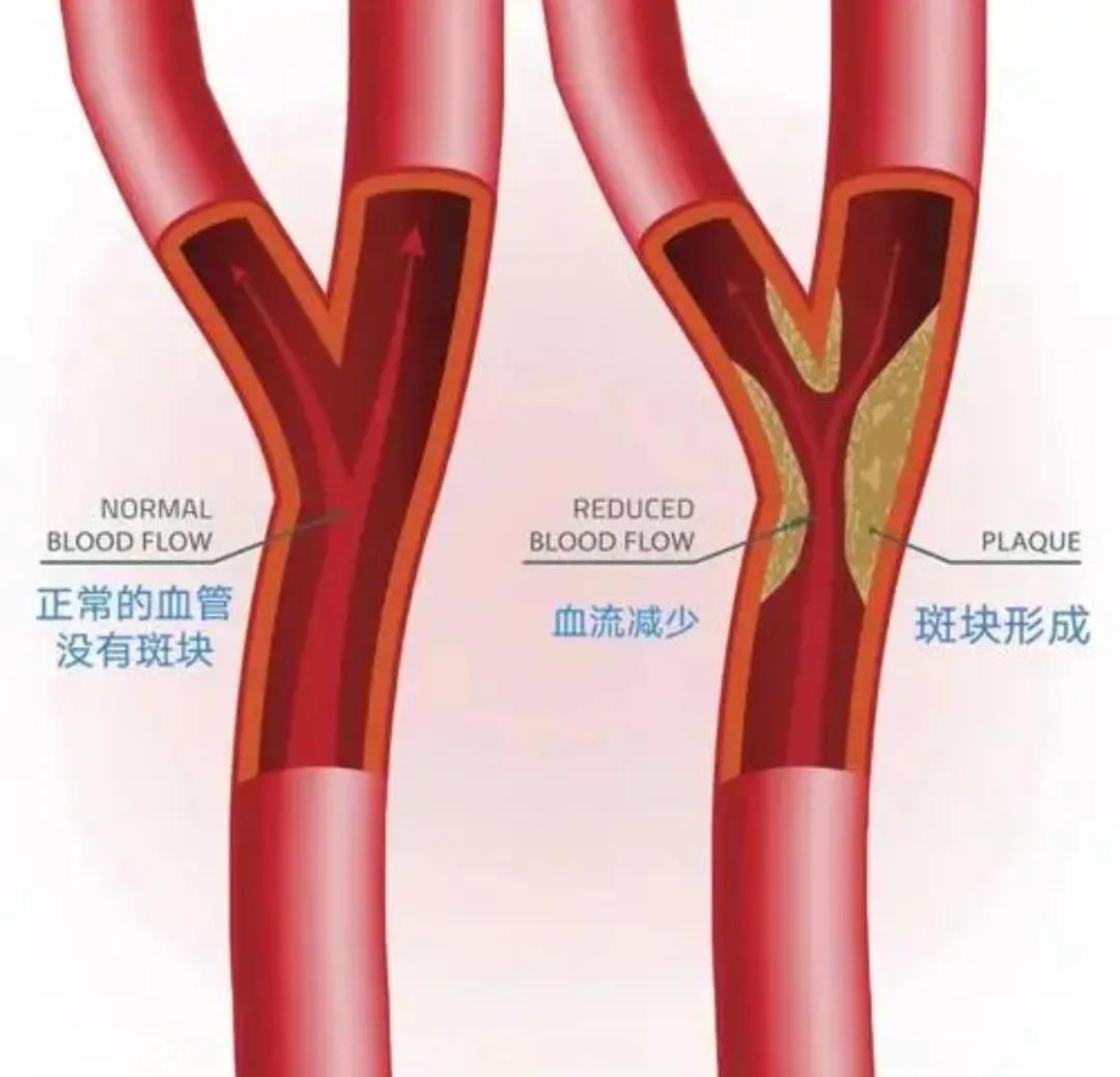 坚持7年，颈动脉斑块“消失”，4种方法“护血管”，真的可以做到