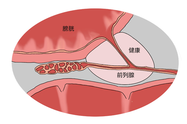 得了前列腺增生，一定要手术吗？医生提醒：3个问题需要弄明白