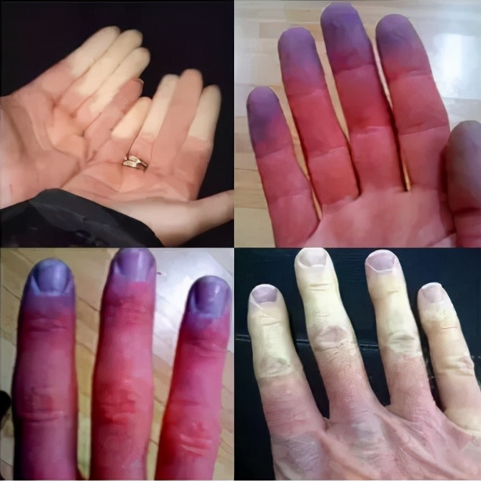 身体有病手指先知？提醒：警惕手指出现的7种变化，或是疾病来袭