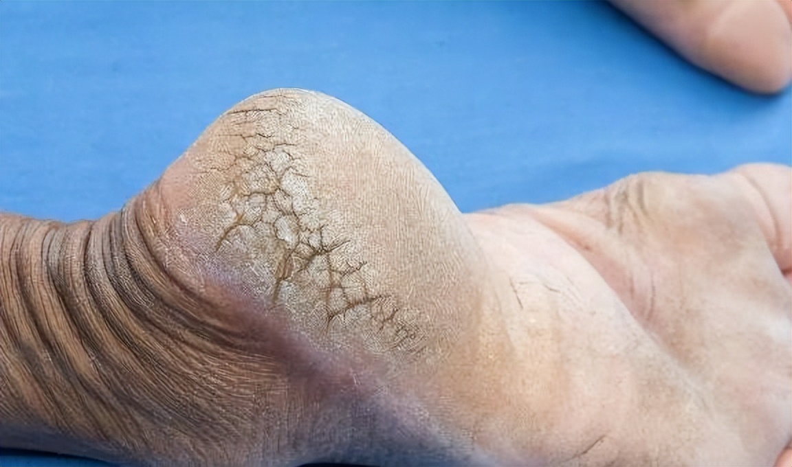 为什么只有脚后跟的皮肤干裂？4个因素是重要原因，要进一步检查