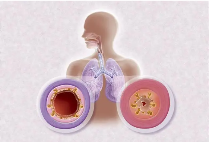 脚后跟痛？不要再忍了！医生提醒：可能与这3种疾病有关