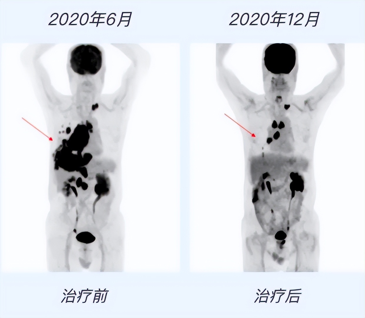 早发现、早治疗 「硬核检测检验」助力肿瘤防治 | 世界防癌日