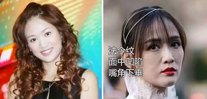 鼻子塌不可怕，面中凹才拉胯，显苦显凶还显老，许多女星深受其害