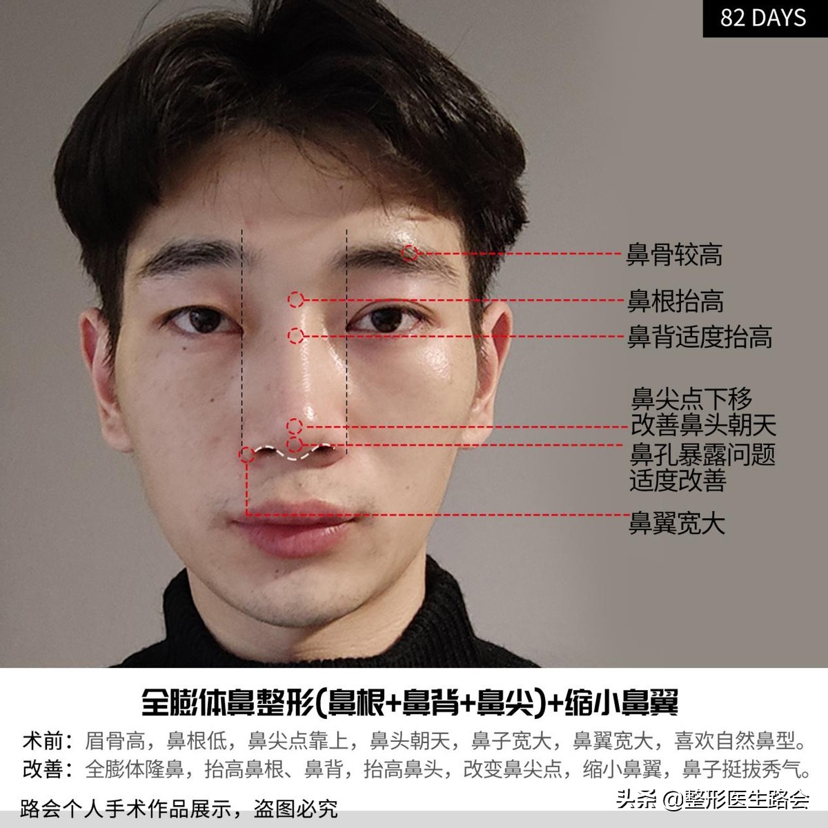 等待2年之久，从海南到北京，鼻整形真实记录，82天后“很惊艳”