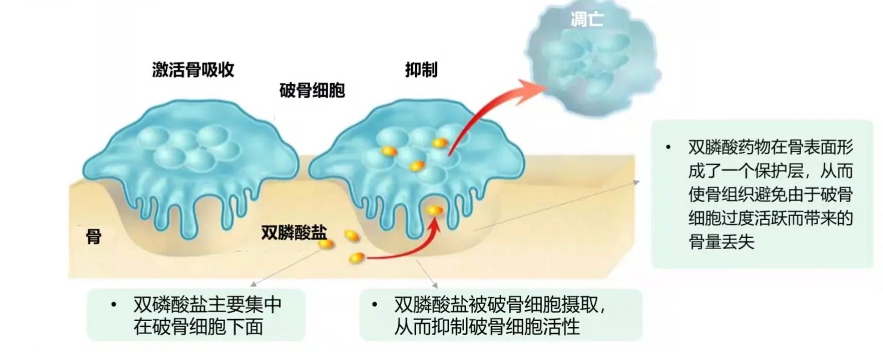 打一针管一年的补钙针“唑来膦酸”真的可以治疗骨质疏松吗？