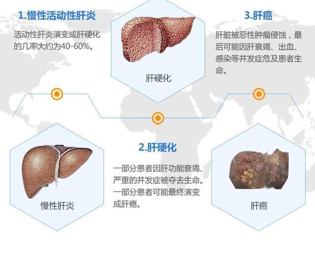 肝脏检查，CT和B超选择哪个更好？想少花冤枉钱，肝病医生告诉你