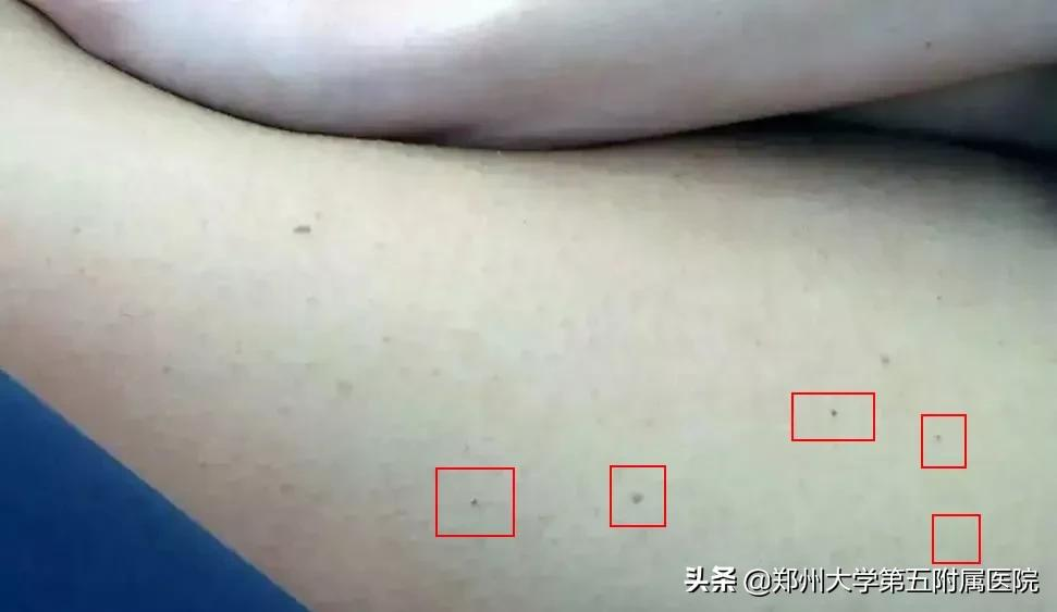 激光祛痣看似简单,这些却不得不知......