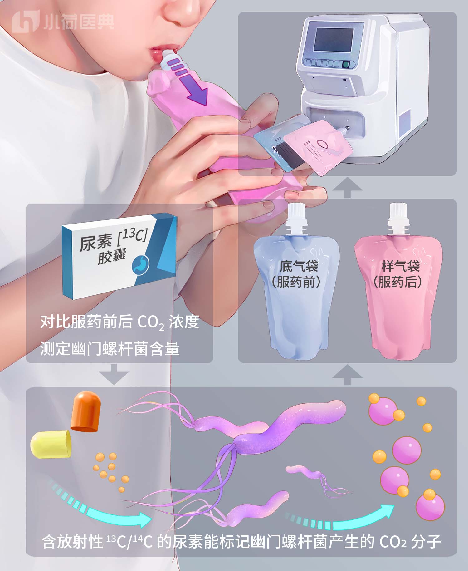 被列为明确致癌物的幽门螺杆菌，到底是什么？
