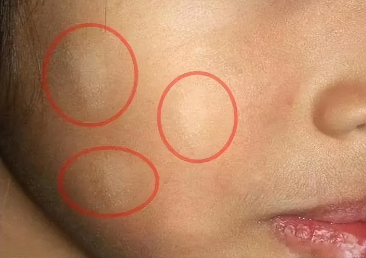 如果是贫血痣,皮肤上的白斑一般是先天性的,在出生时或者童年时期都会