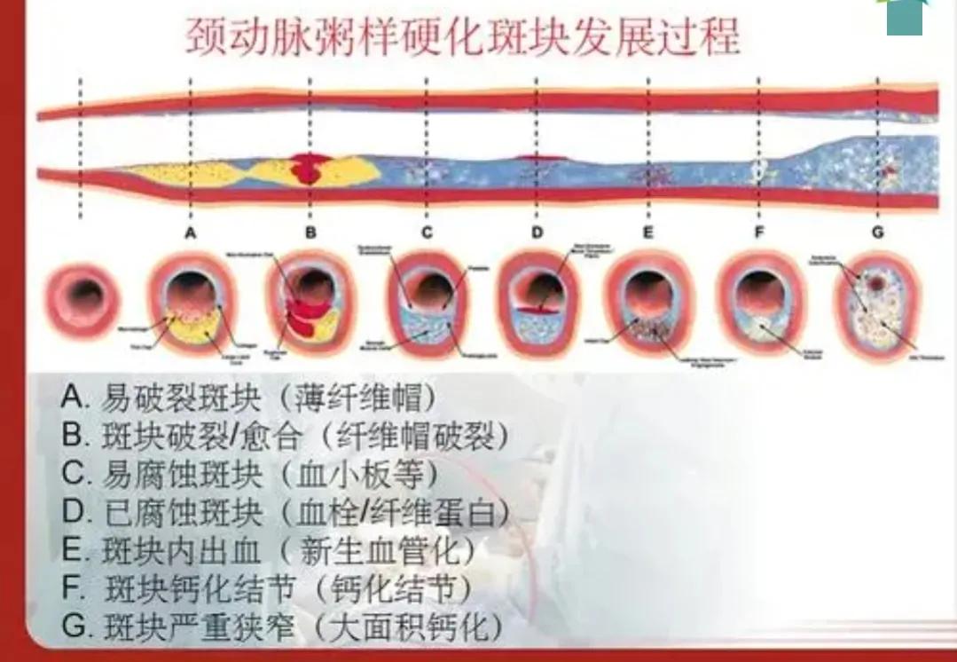 坚持7年，颈动脉斑块“消失”，4种方法“护血管”，真的可以做到