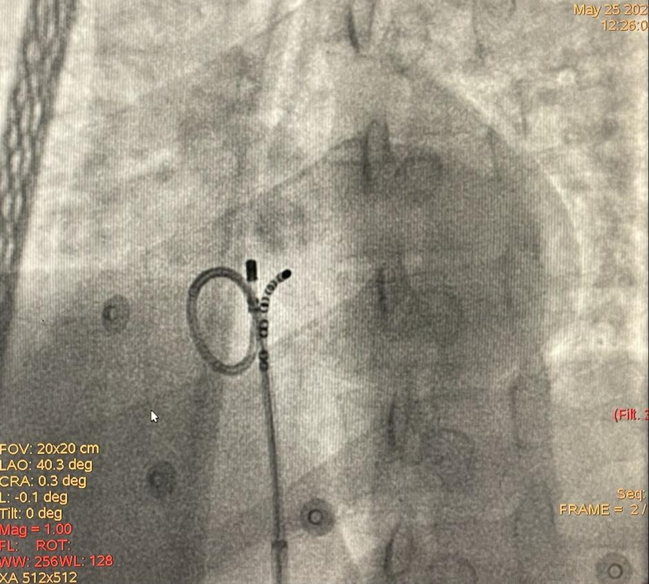 仁医病例丨方哲参与指导多例疑难性室早射频消融治疗