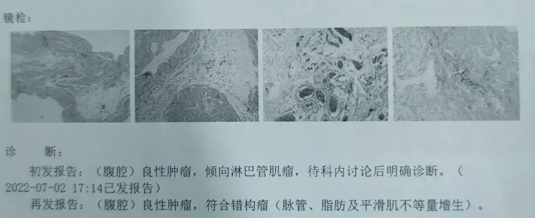 花季少女腹藏巨大肿瘤！省人民医院精心“拆弹”解难题
