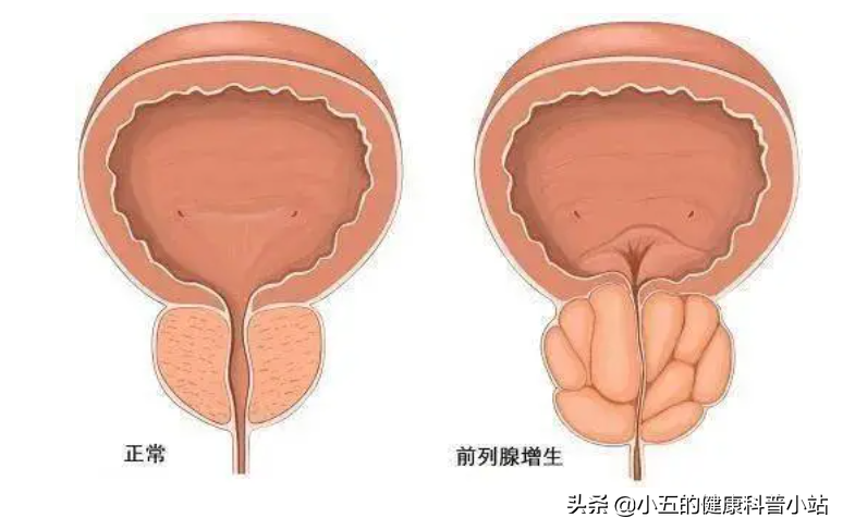 坦索罗辛和非那雄胺是治疗前列腺增生的常用方案，为什么要联用？