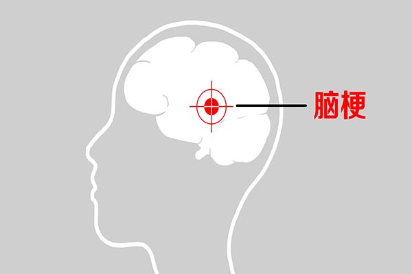 55岁以后，不想脑梗死发作，远离3物，坚持3事，养护好血管