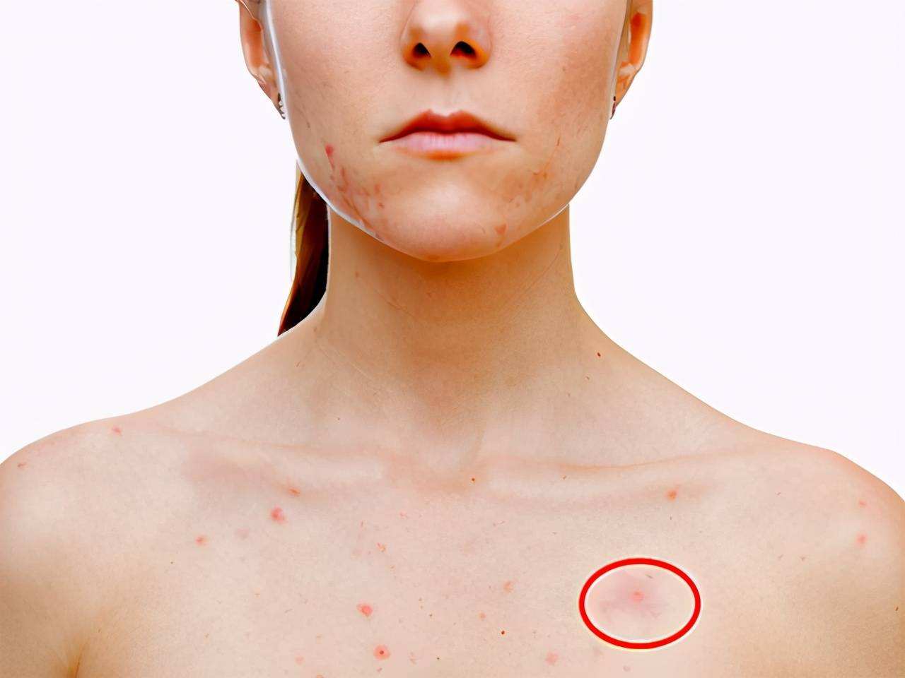 有蜘蛛痣就是有肝病了?数量多颜色深是病情加重?如何才能消失?