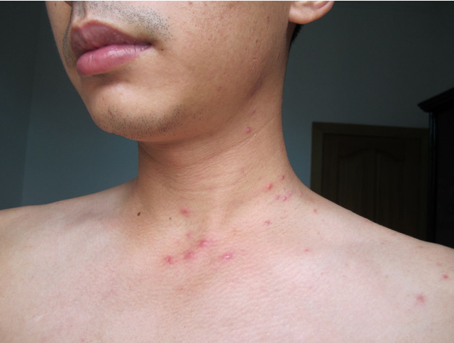 男子错把艾滋病当成皮肤病?出现艾滋病后,哪些表现比较明显?