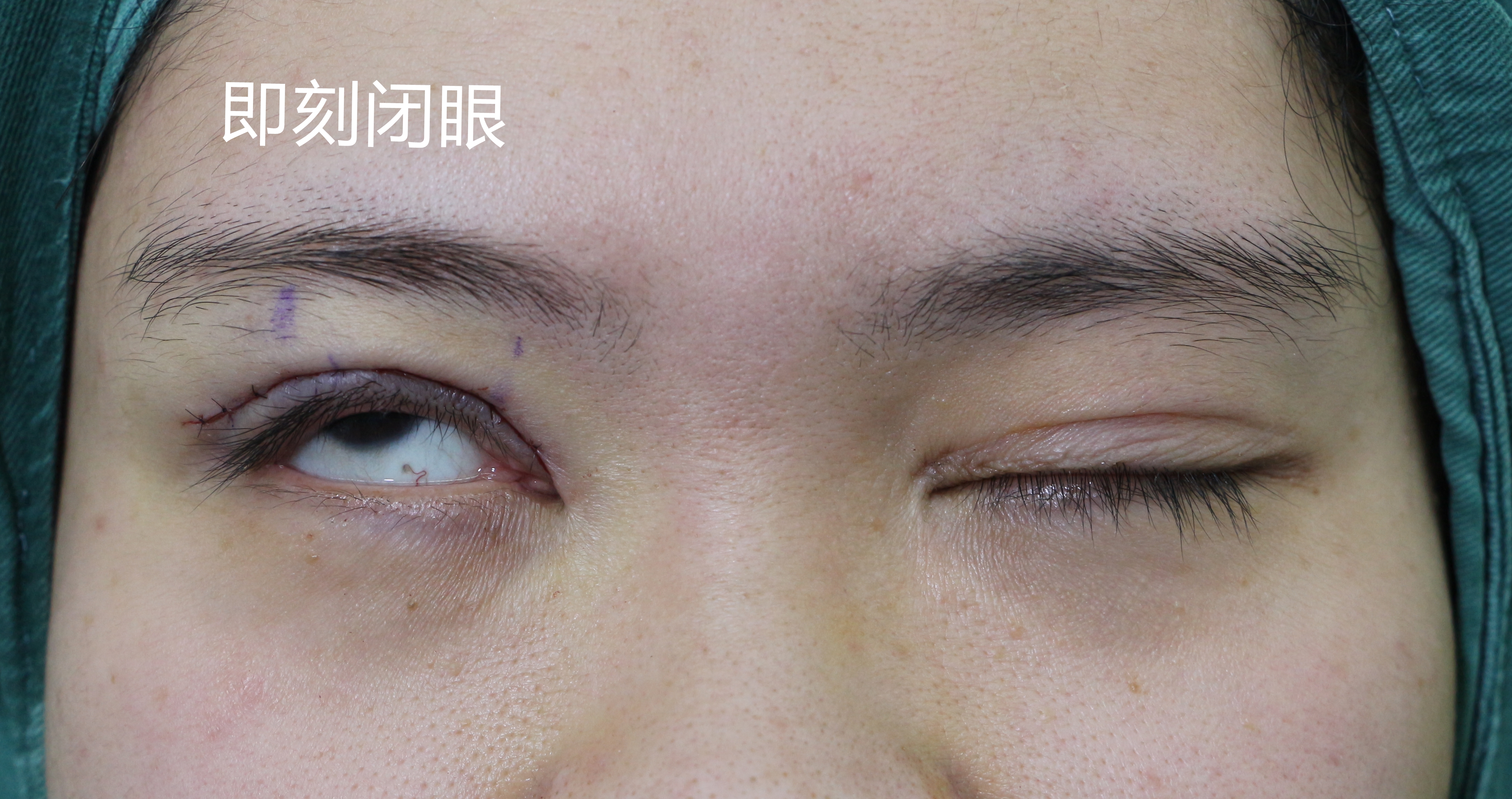 眼皮下垂手术多少钱(河北90后姑娘右眼上睑下垂做了一次效果不好)