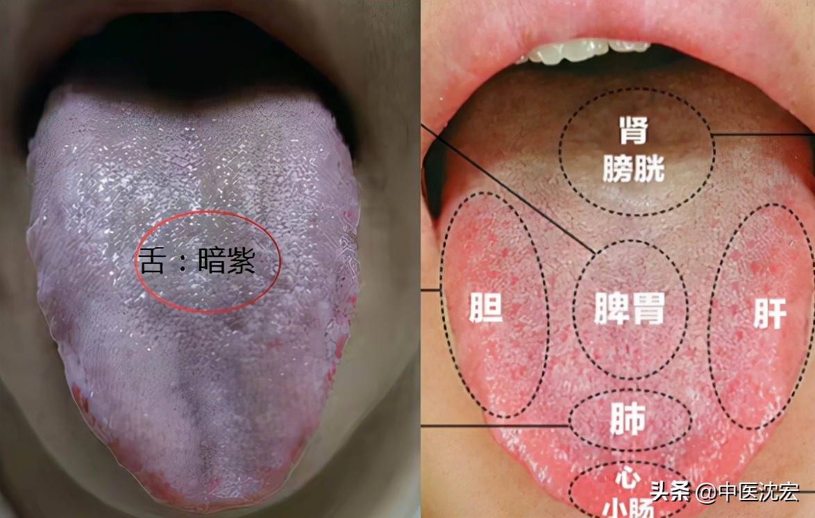 体内有瘀用血府逐瘀没用？舌象告诉你原因，2味中药、去瘀生新