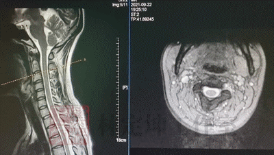 怀疑自己得了颈椎病，到底是做X光片、CT还是核磁？答案都在这