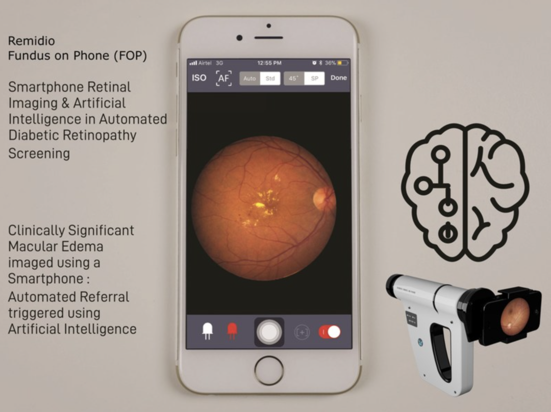 Remidio：手机+AI也能成为医疗器械潜力股｜前哨