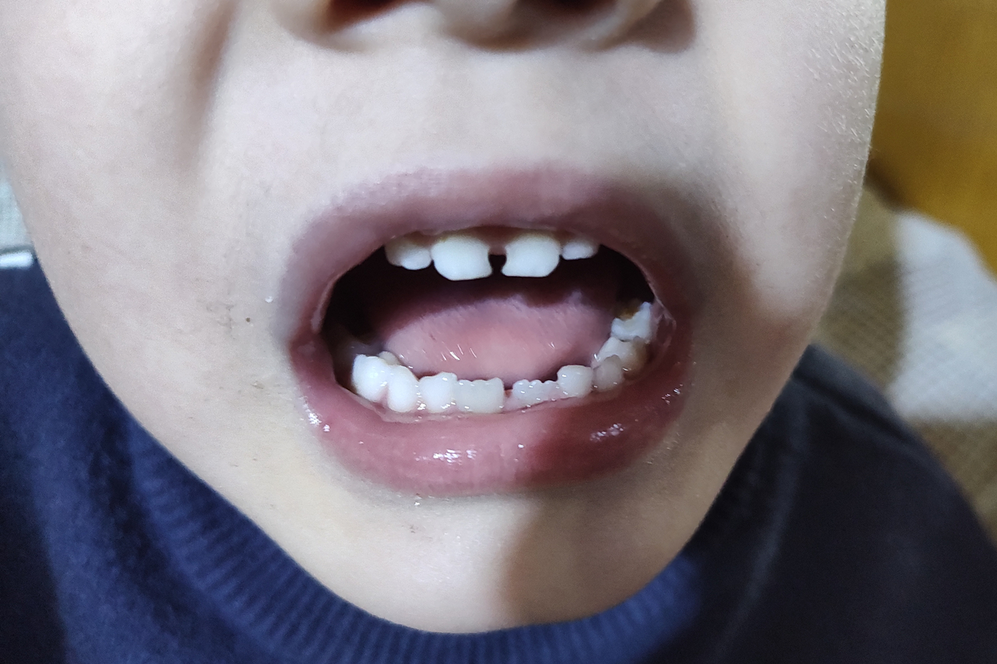 门牙龋齿初期图片