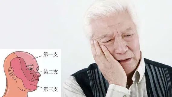 中医药大学金沙洲医院唐运林教授：三叉神经痛应该怎样治疗？