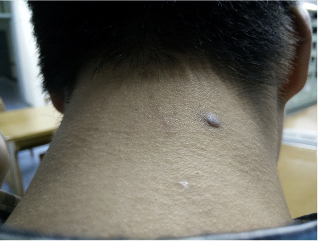 脖子上长出了"小肉粒",别只顾影响美观,也会影响健康