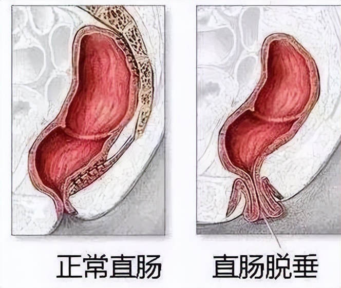 仁医新术丨利用经肛微创外科技术成功治疗多例重度直肠脱垂高龄老年患者