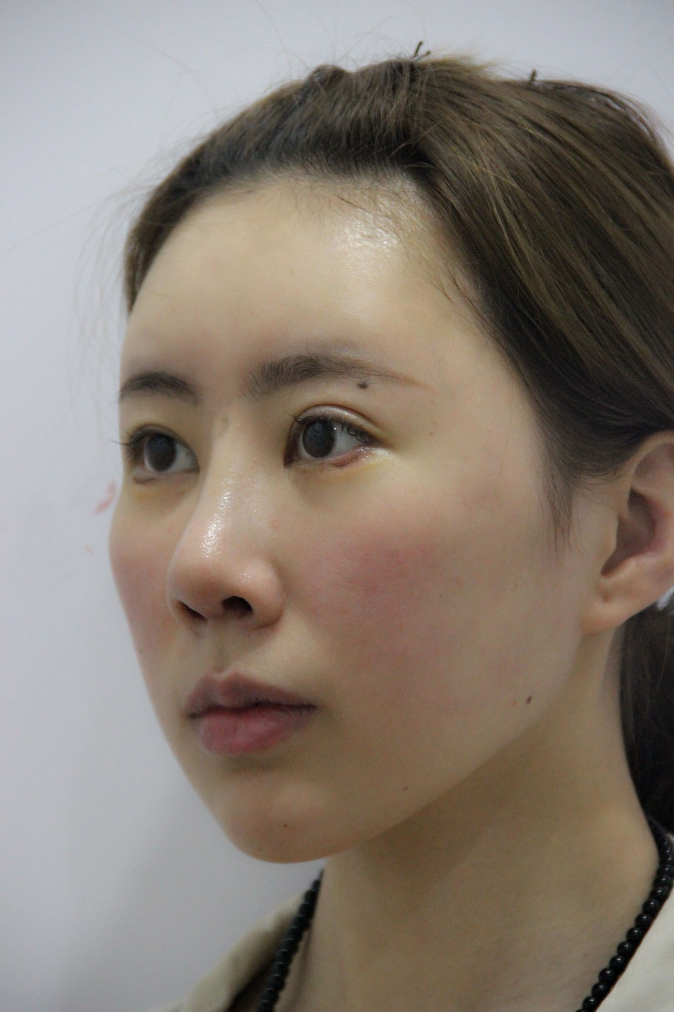 32岁宝妈自体脂肪填充50天，亲戚以为我悄悄地换了一张脸