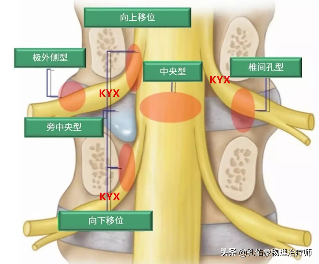 同样是腰椎间盘突出，为什么有人痛不欲生，有人却安然无恙？