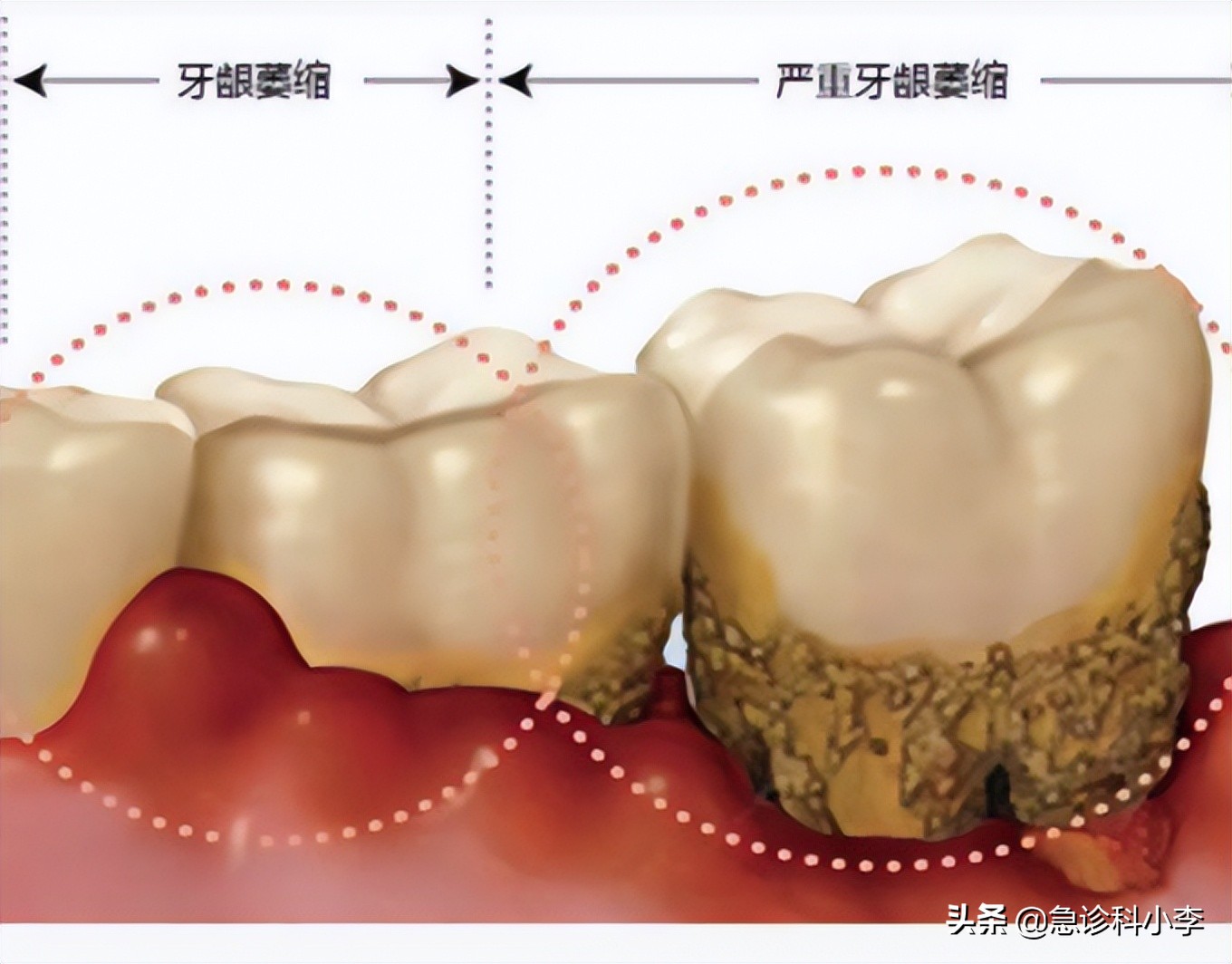 为什么医生不推荐洗牙深层的牙结石怎么洗(牙缝里的牙结石，如何清除干净？医生：3个办法是不少人的选择)