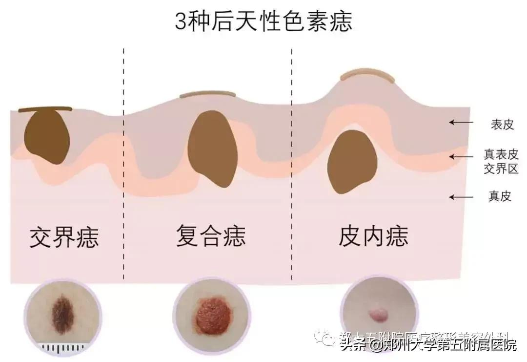 激光祛痣看似简单,这些却不得不知......