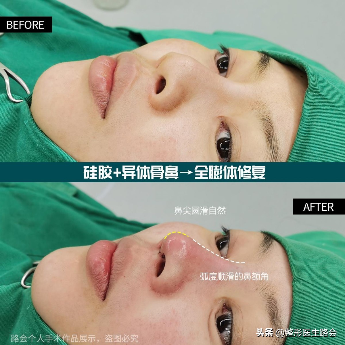 真实效果展示:当硅胶假体取出后,你的鼻子会变成什么样?