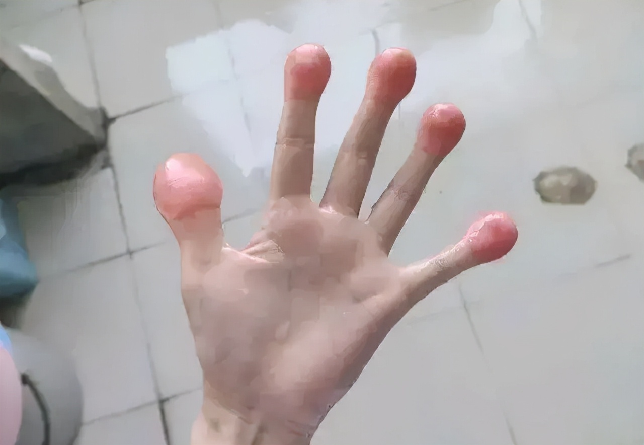 身体有病手指先知？提醒：警惕手指出现的7种变化，或是疾病来袭