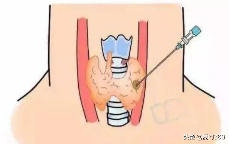 甲状腺有问题的几个表现，预防甲状腺结节的小妙招，你知道几个？