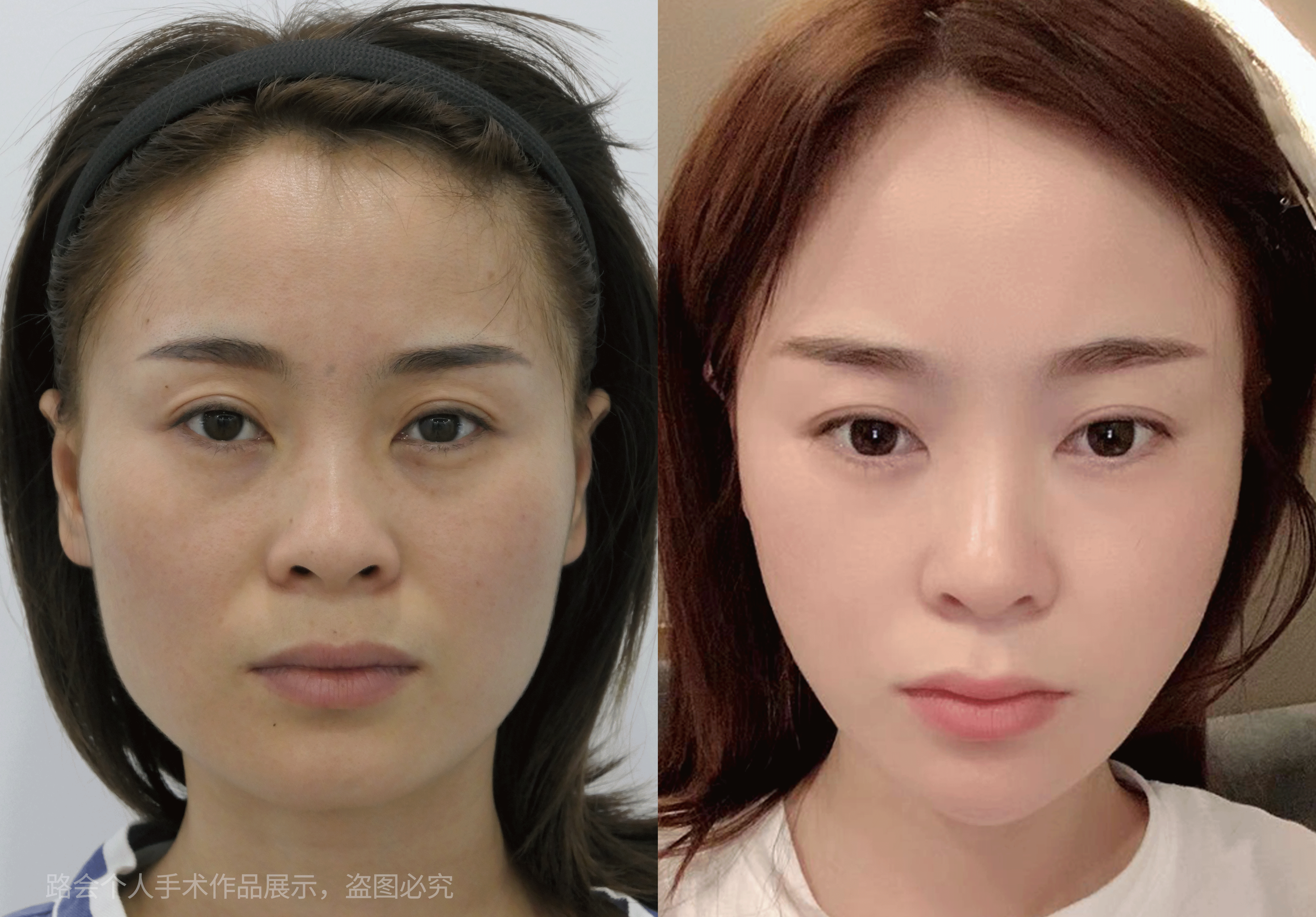 botox瘦脸针市场价格(我的青春不一样)