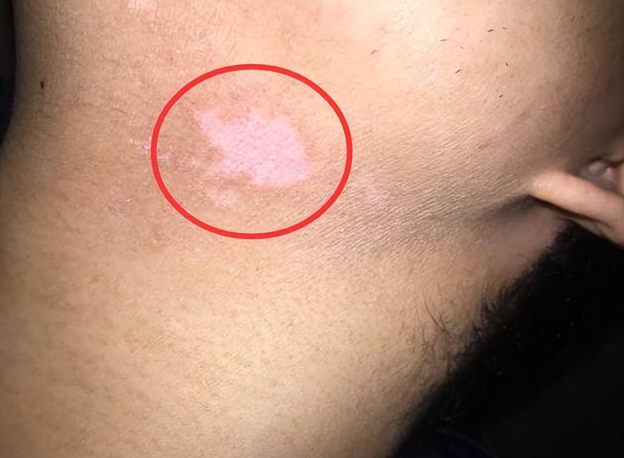 皮肤上长白斑,白点是啥病?怎么回事?3大诱因你知道吗?