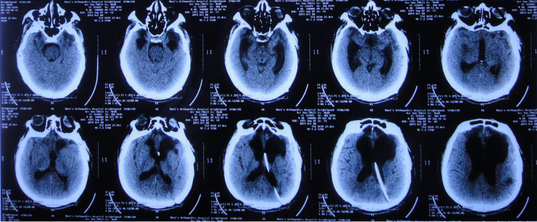 脑外伤颅骨修补术和分流术后脑积水加重致昏迷