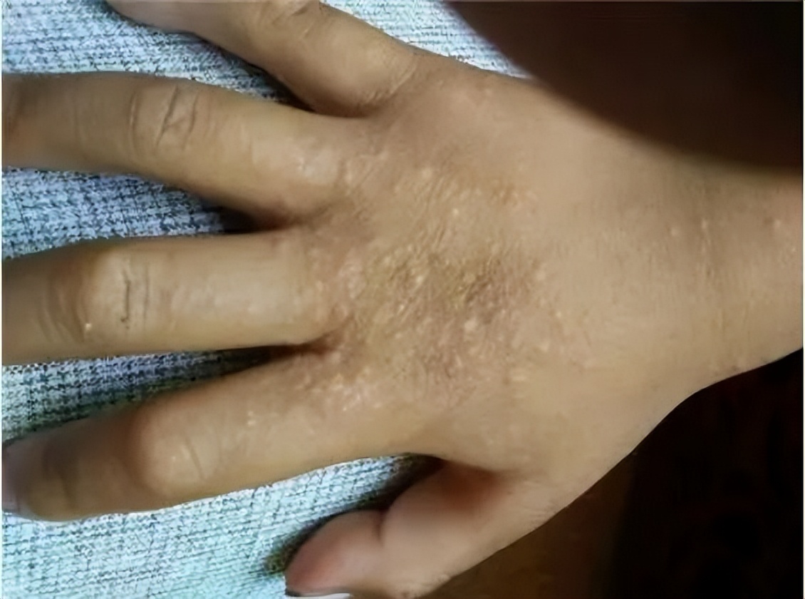 夏天孩子身上常见的几种小疙瘩,再痒也别抠,小心越来越多