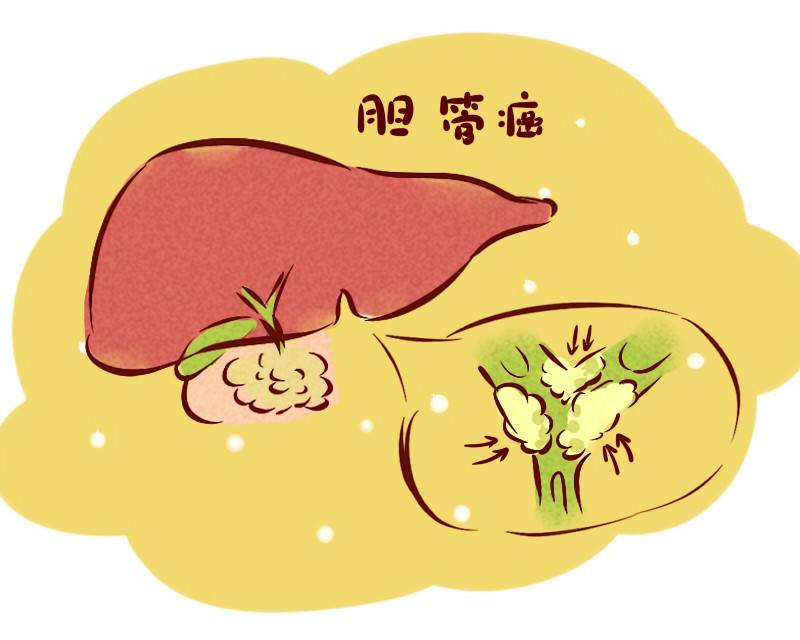 切除胆囊对身体有影响？什么时候需要切除？不妨看看医生的建议