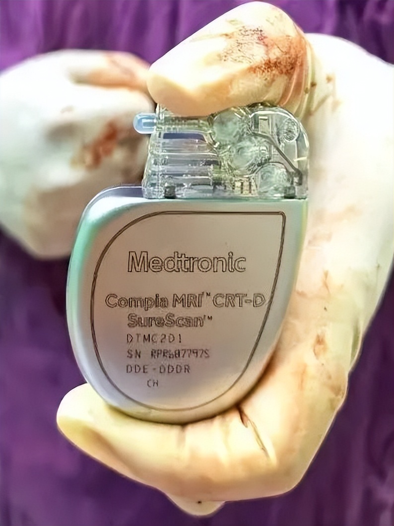 仁医新术丨江西省心血管病医院成功植入全省首例兼容3.0TMRI的CRTD