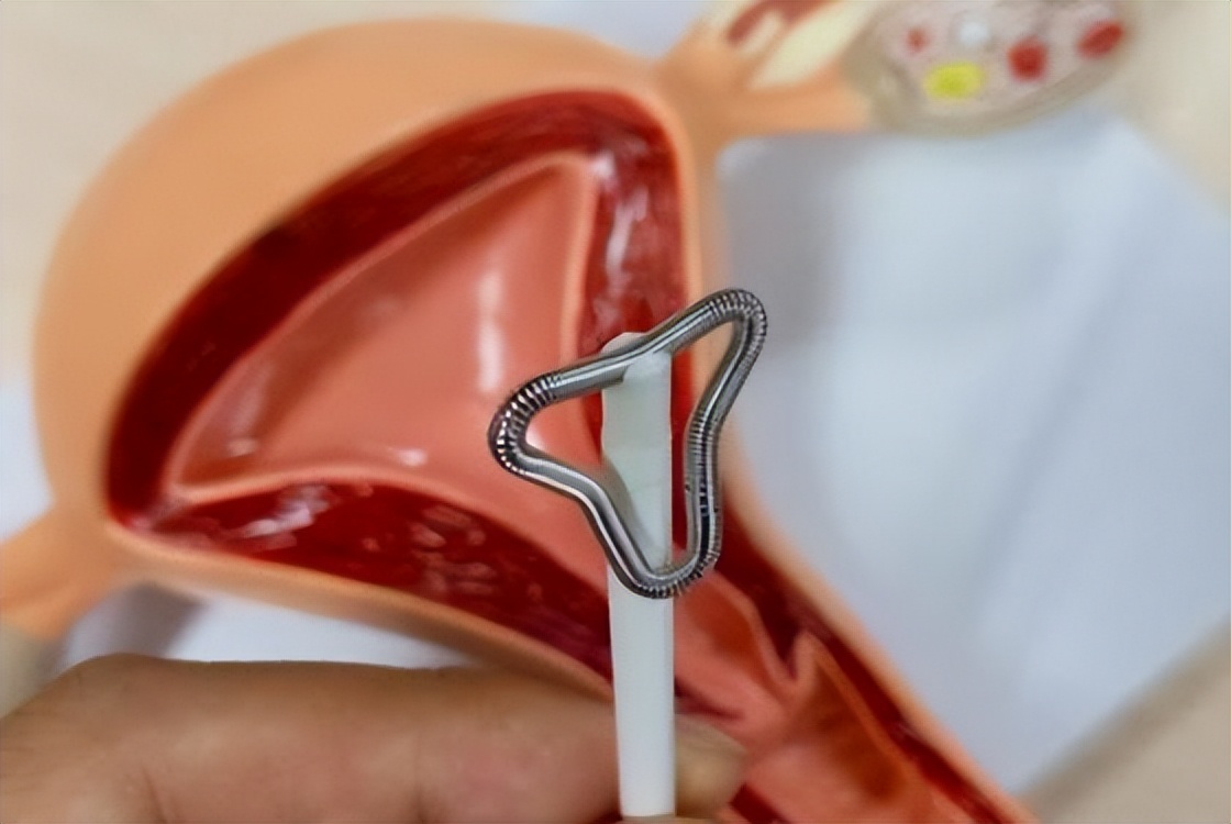 节育环长期不取出,会长进肉里吗?医生:取环,最好别超这个年龄